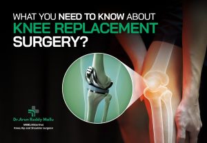 Knee Replacement Surgery