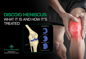 Discoid Meniscus