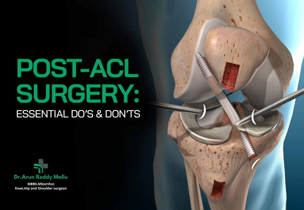 After Acl Surgery Recovery